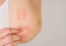 Sedef Hastalığı (Psoriasis) Nedir ve Belirtileri Nelerdir?