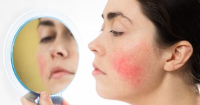 Gül Hastalığı (Rosacea) Nedir? Nedenleri Nelerdir?