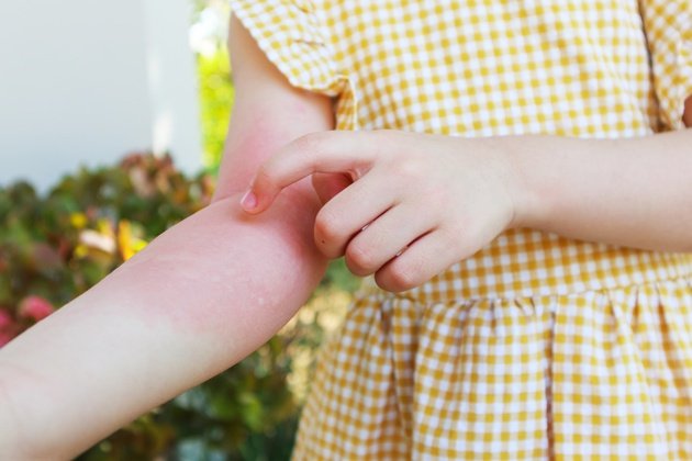Beşinci Hastalık (Parvovirüs B19) Nedir ve Nasıl Tedavi Edilir?