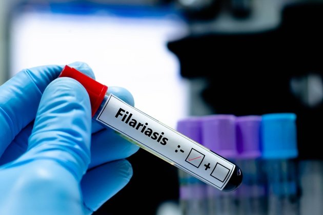 Fil Hastalığı (Lenfödem) Nedir ve Neden Oluşur?