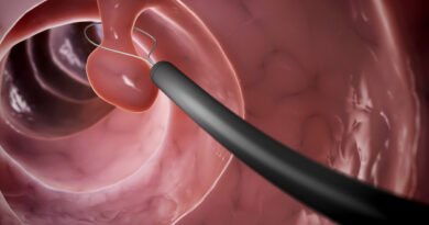 Polip Nedir? Belirtileri ve Tedavi Yöntemleri Nelerdir?