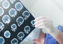 Epilepsi (Sara) Nedir? Belirtileri ve Tedavi Yöntemleri