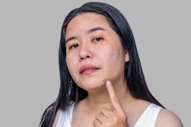 Spot Treatment for Skin Imperfections | Anadolu Health Center Hospital