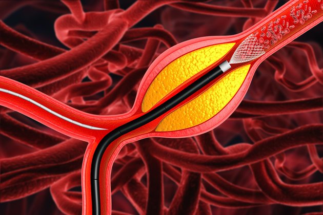 El Bileğinden Radial Anjiyo ile Aynı Gün Taburcu Olma İmkanı