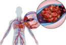 Pulmoner Emboli: Tanım, Belirtiler, Teşhis ve Tedavi Yöntemleri