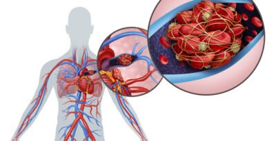 Pulmoner Emboli: Tanım, Belirtiler, Teşhis ve Tedavi Yöntemleri