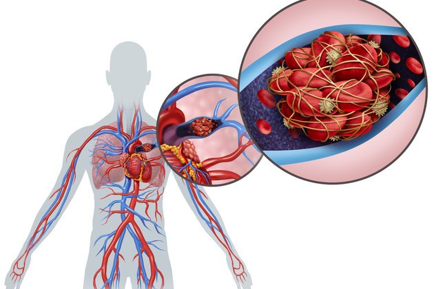 Pulmoner Emboli: Tanım, Belirtiler, Teşhis ve Tedavi Yöntemleri