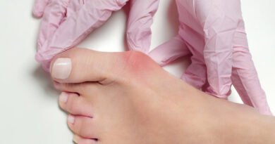 Halluks Valgus: Tanımı, Ameliyat Süreci ve Sonrası Hayat
