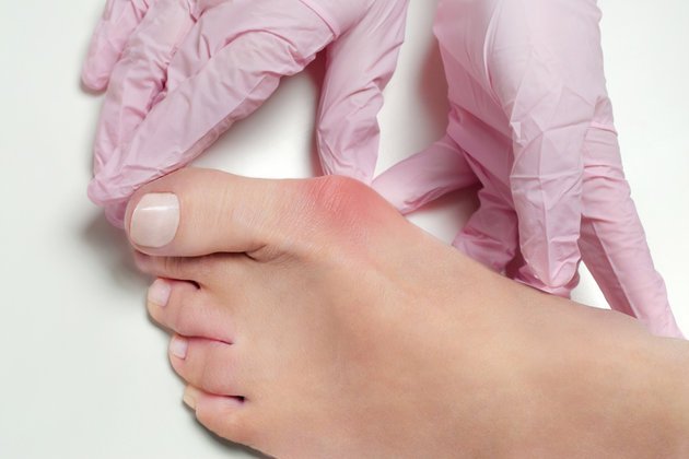 Halluks Valgus: Tanımı, Ameliyat Süreci ve Sonrası Hayat