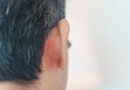 Seboreik Dermatit: Tanımı, Nedenleri, Belirtileri ve Tedavi Yöntemleri