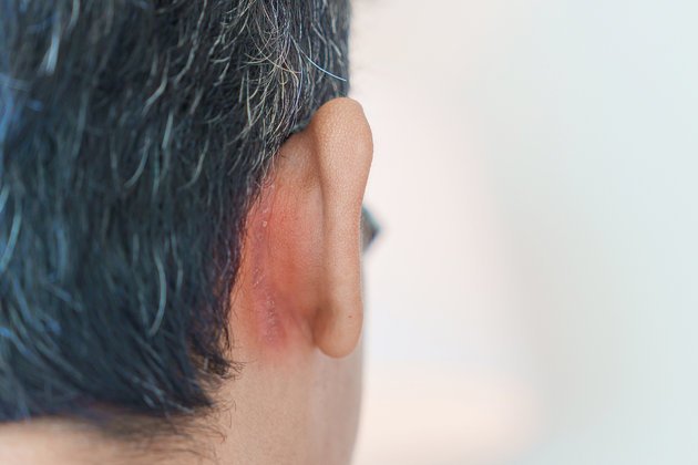Seboreik Dermatit: Tanımı, Nedenleri, Belirtileri ve Tedavi Yöntemleri