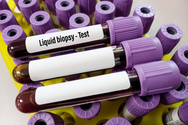 Likit Biyopsi Nedir ve Nasıl Uygulanır?