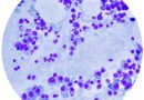 Multiple Myeloma | Anadolu Health Center Hospital