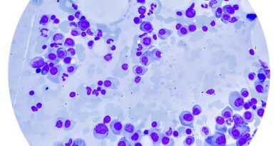Multiple Myeloma | Anadolu Health Center Hospital