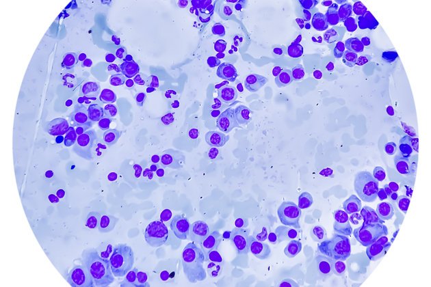 Multiple Myeloma | Anadolu Health Center Hospital