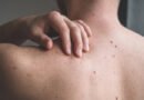 Bazal Hücreli Karsinom (BHK) Nedir ve Nasıl Tedavi Edilir?