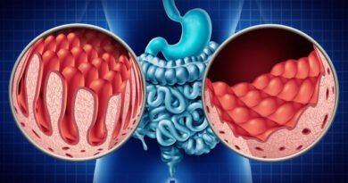 Bağırsak Düğümlenmesi: Nedir, Belirtileri ve Tedavi Yöntemleri