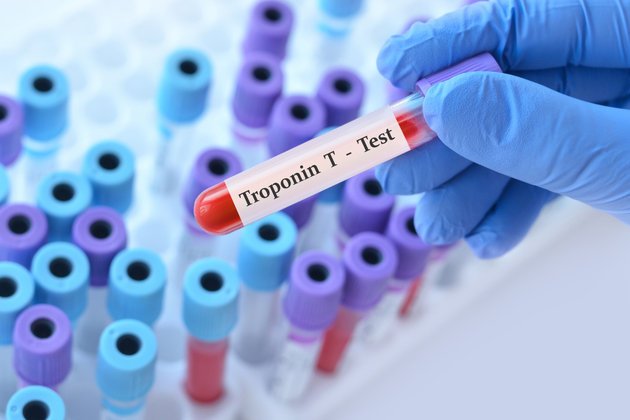 Troponin Nedir? Yüksek ve Düşük Troponin Düzeyleri Üzerine Bilgiler