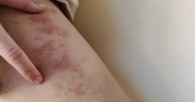 Purpura Nedir? | Anadolu Sağlık Merkezi