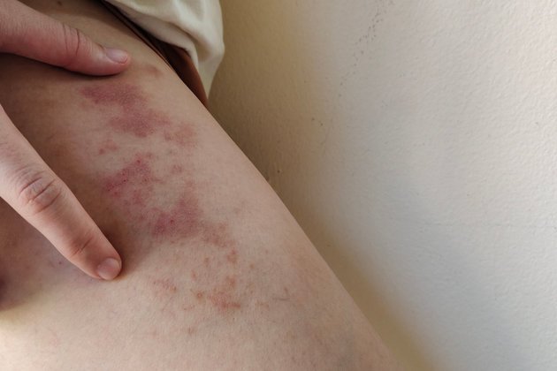Purpura Nedir? | Anadolu Sağlık Merkezi