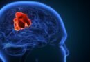 Glioblastom (GBM) Nedir? Belirtileri Nelerdir?