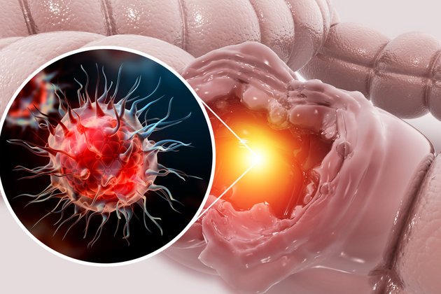 Rektum Kanseri Nedir ve Belirtileri Nelerdir?