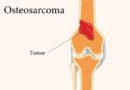 Osteosarkom Nedir? Belirtileri ve Tedavi Yöntemleri
