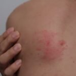 Candida Mantarı: Nedir? Belirtileri, Nedenleri ve Tedavi Yöntemleri