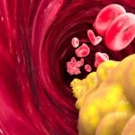 Damar Sertliği (Ateroskleroz) Nedir? Belirtileri Nelerdir?