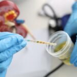 İdrar Kültürü Nedir ve Neden Uygulanır?