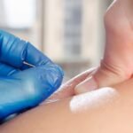 Akupunktur Nedir ve Hangi Rahatsızlıklara İyi Gelir?