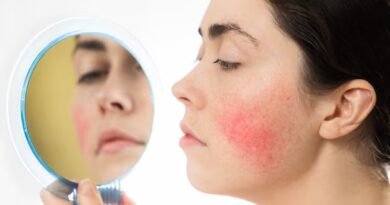 Ataksi Telenjiektazi Nedir? Nedenleri, Belirtileri ve Tedavi Yöntemleri