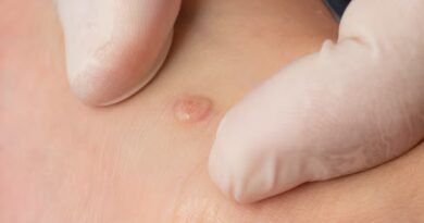 Eritema Multiforme: Nedir, Nedenleri, Belirtileri ve Tedavi Yöntemleri