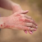 Tinea Corporis: Nedir, Nedenleri, Belirtileri ve Tedavi Yöntemleri