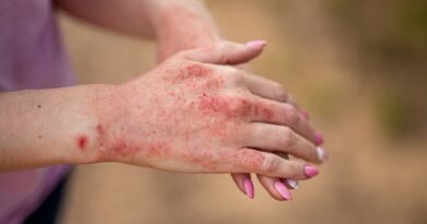 Tinea Corporis: Nedir, Nedenleri, Belirtileri ve Tedavi Yöntemleri