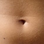 Göbek Deliği İltihabı: Nedir, Belirtileri ve Tedavi Yöntemleri