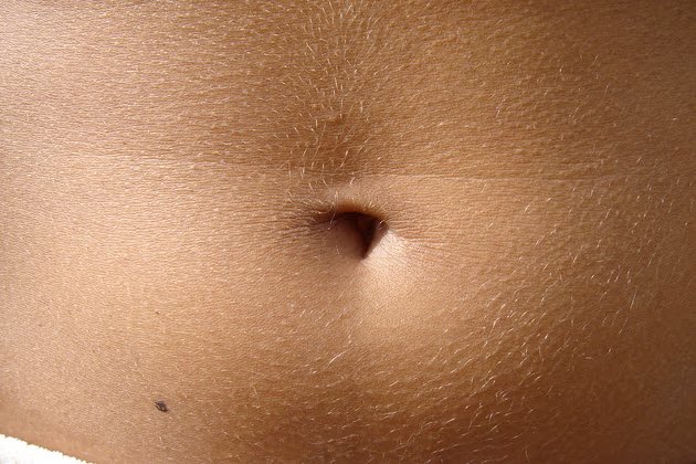 Göbek Deliği İltihabı: Nedir, Belirtileri ve Tedavi Yöntemleri