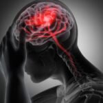 Geçici İskemik Atak (TIA) Nedir? Nedenleri, Belirtileri ve Tedavi Yöntemleri Nelerdir?