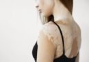 Melanin Nedir? Melanin Eksikliğinin Nedenleri Nelerdir?
