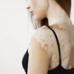 Melanin Nedir? Melanin Eksikliğinin Nedenleri Nelerdir?