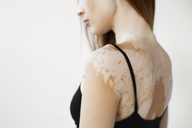 Melanin Nedir? Melanin Eksikliğinin Nedenleri Nelerdir?